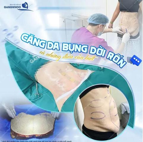 Phẫu thuật căng da bụng giúp loại bỏ mỡ thừa, da chùng và mang lại vòng eo săn chắc. Bài viết hướng dẫn chi tiết quy trình, cách chăm sóc hậu phẫu và các lưu ý quan trọng để đạt kết quả tối ưu và an toàn.