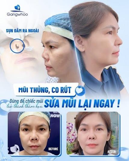 dấu hiệu nâng mũi bị viêm