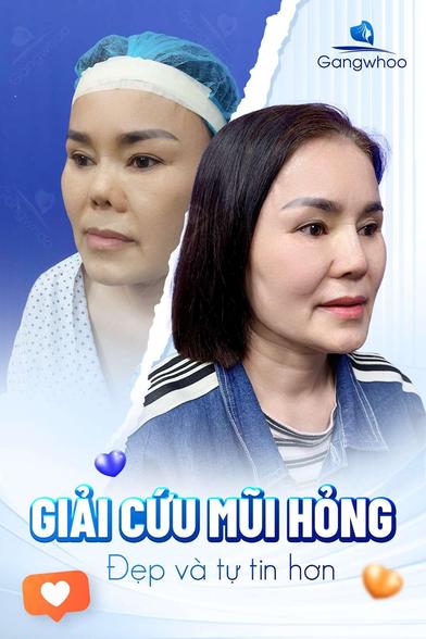 nâng mũi bị nhiễm trùng