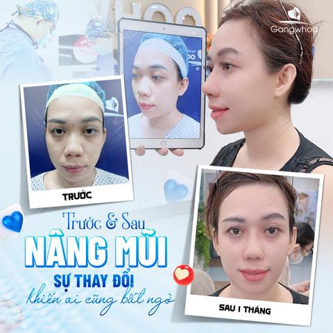 đầu mũi to sau khi nâng
