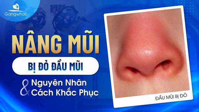 nâng mũi bị đỏ đầu mũi