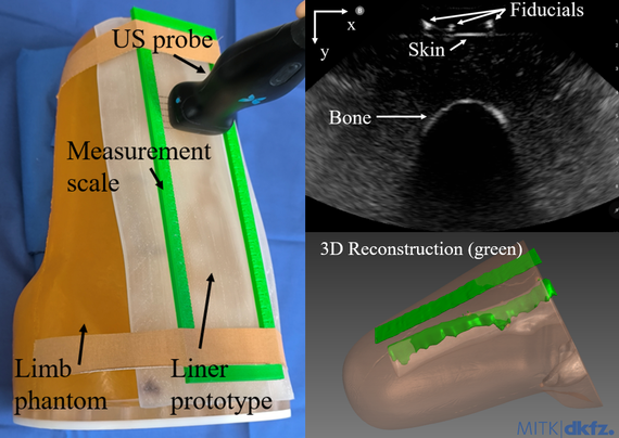 Image showing the Scanliner prototype on a limb phantom (left), a corresponding ultrasound image with visible fiducial markers, skin, and bone (top right), and the resulting 3D reconstruction in MITK (bottom right).
