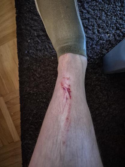 Photo of my Shin with bloody scratches