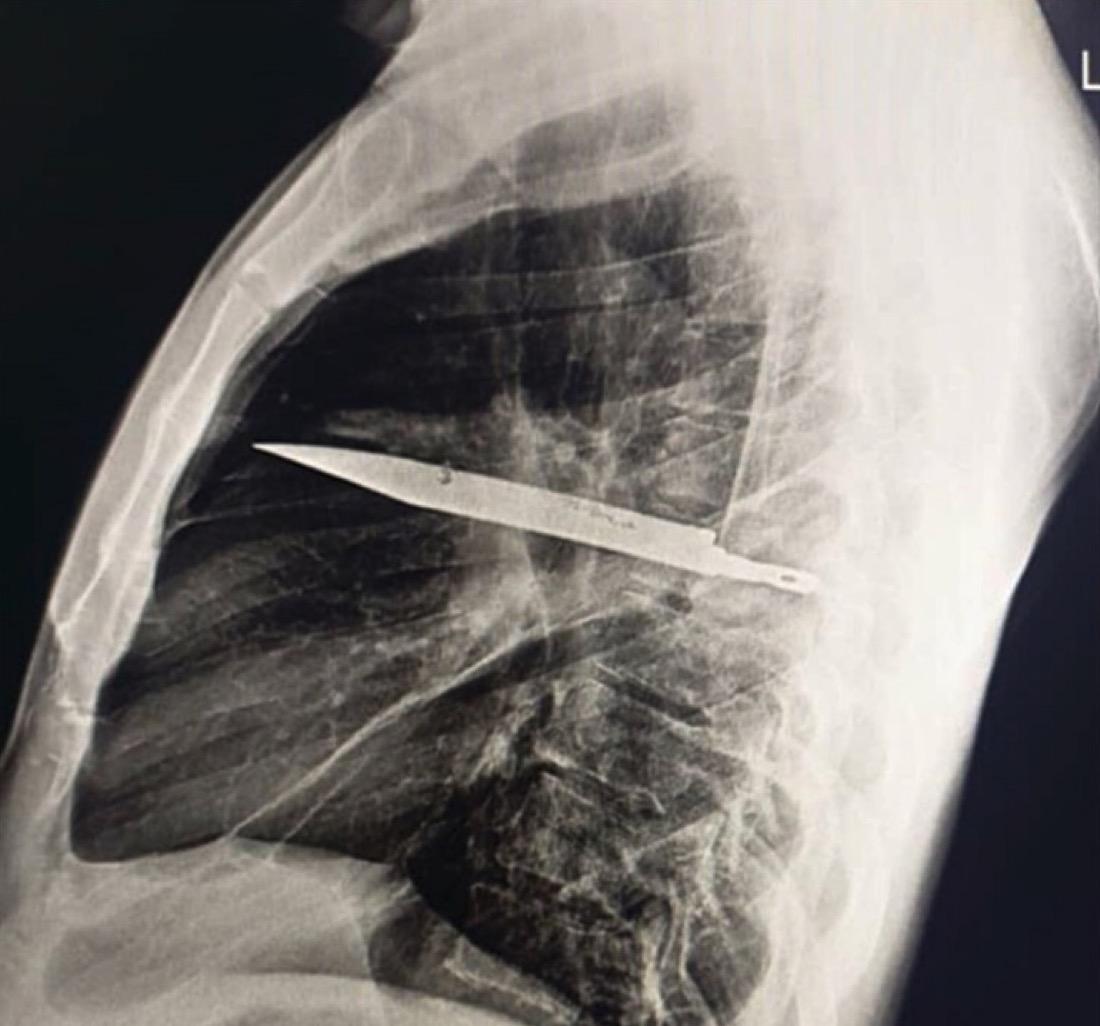 X-ray image showing a side view of a blade embedded in a chest