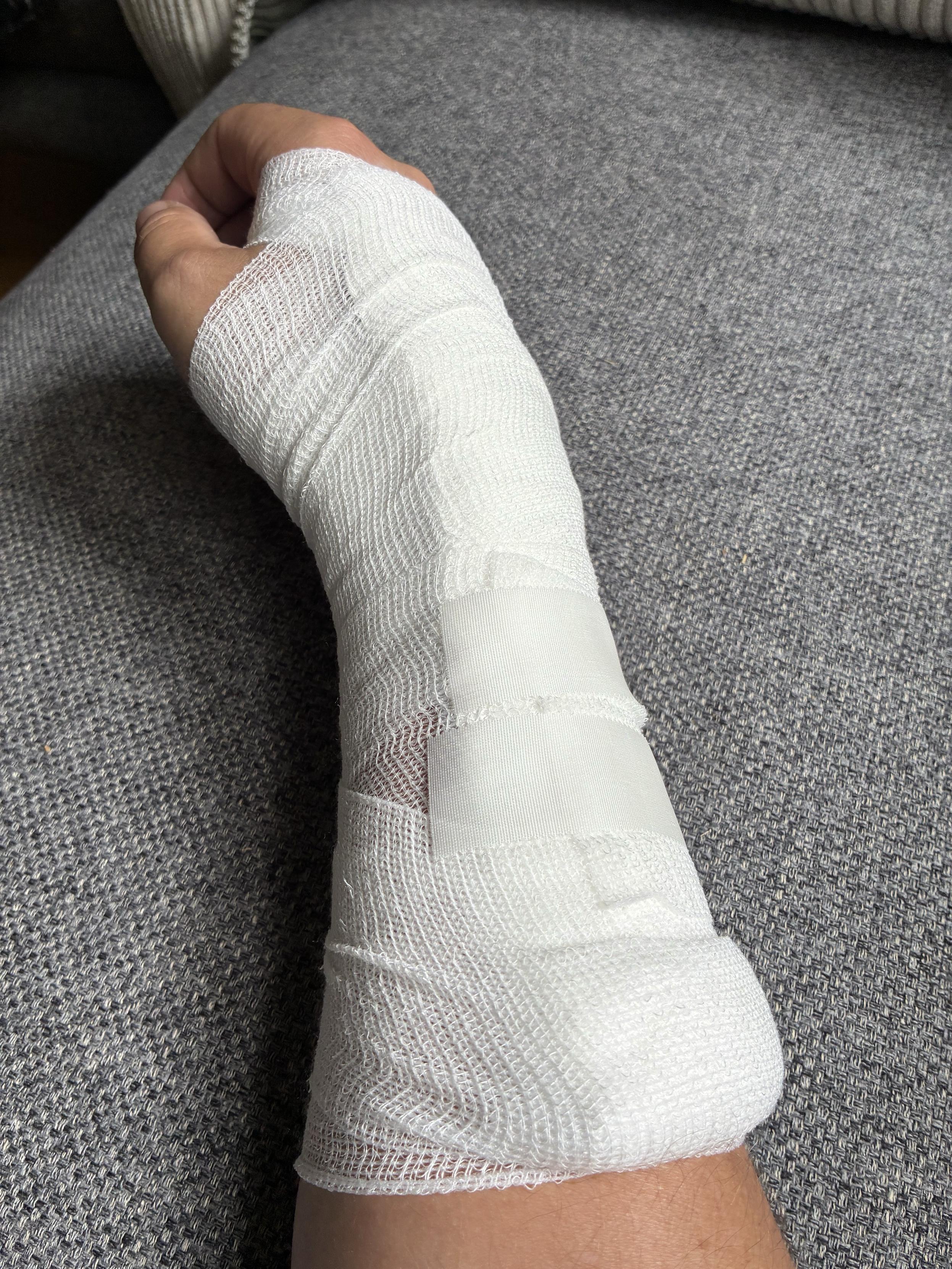 Rechter Arm mit einer Gipsschiene und mit Verband umwickelt