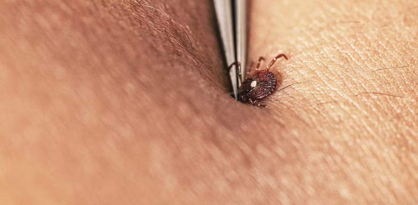 A person uses tweezers to pull a tick out of skin.