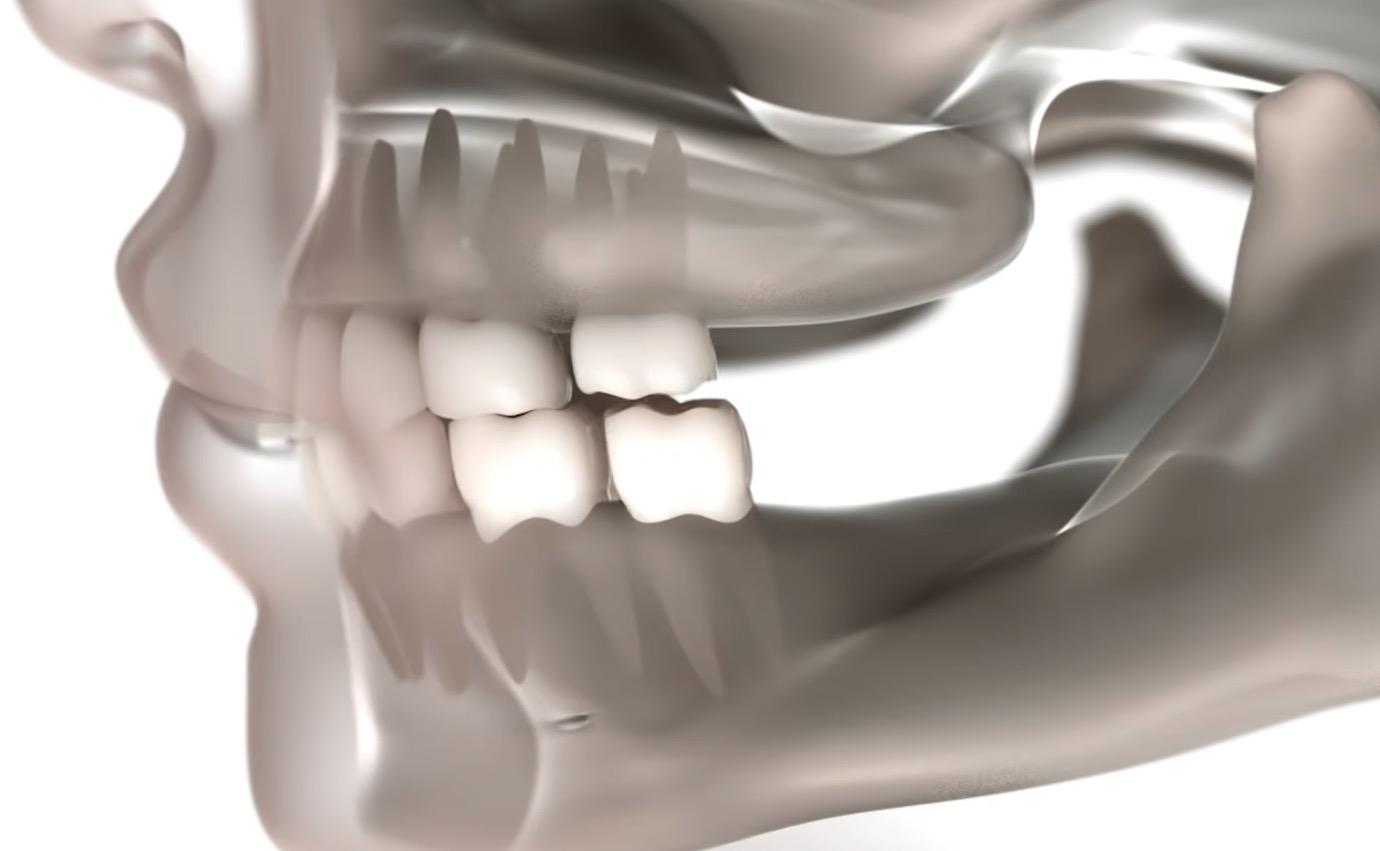 CGI teeth