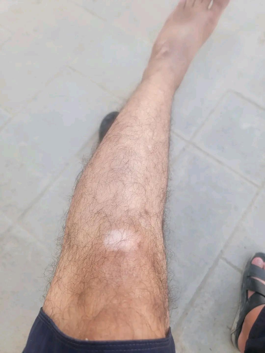 Skin diseases
