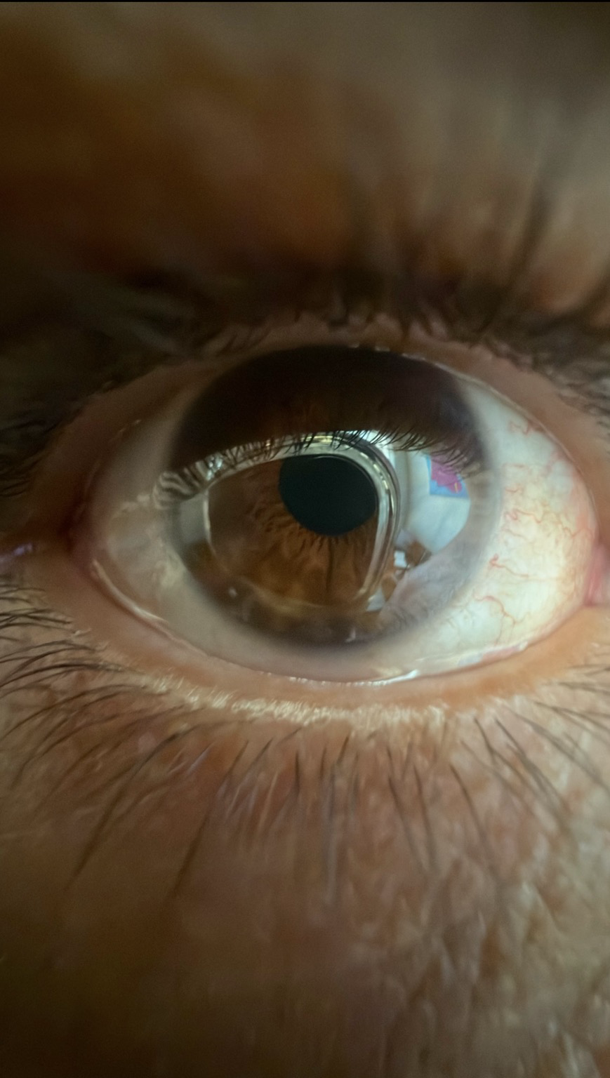 Macro image of my eye close up. You can see the reflection of the phone in my eye and some red veins